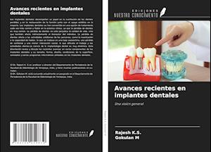 Avances recientes en implantes dentales