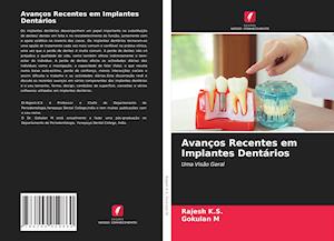 Avanços Recentes em Implantes Dentários