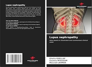 Lupus nephropathy