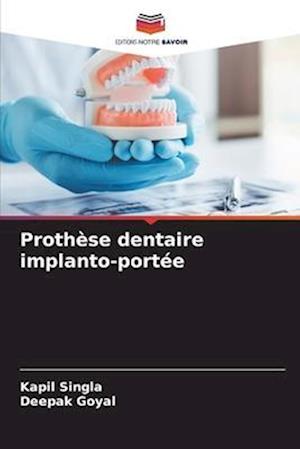 Prothèse dentaire implanto-portée