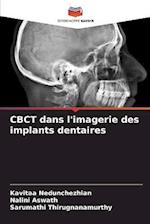 CBCT dans l'imagerie des implants dentaires