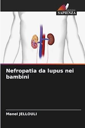 Nefropatia da lupus nei bambini