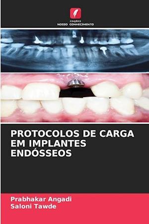 PROTOCOLOS DE CARGA EM IMPLANTES ENDÓSSEOS