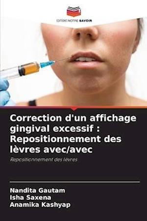Correction d'un affichage gingival excessif : Repositionnement des lèvres avec/avec