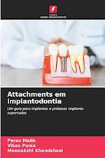 Attachments em implantodontia