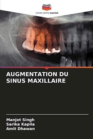 Augmentation Du Sinus Maxillaire