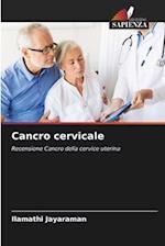 Cancro cervicale