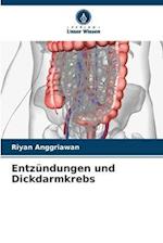 Entzündungen und Dickdarmkrebs