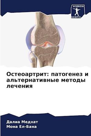 Osteoartrit: patogenez i al'ternatiwnye metody lecheniq