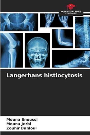 Langerhans histiocytosis