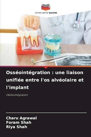 Osséointégration : une liaison unifiée entre l'os alvéolaire et l'implant