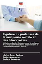 Ligature du prolapsus de la muqueuse rectale et des hémorroïdes