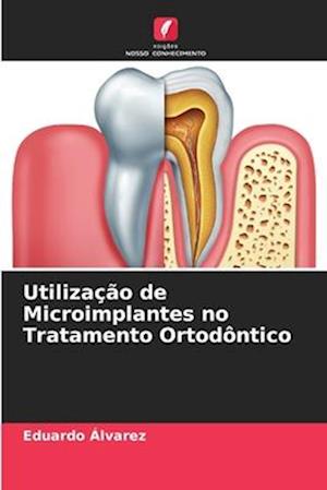 Utilização de Microimplantes no Tratamento Ortodôntico