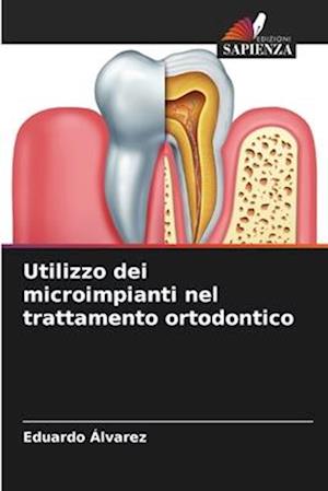 Utilizzo dei microimpianti nel trattamento ortodontico