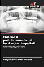 Chiarire il posizionamento dei terzi molari impattati