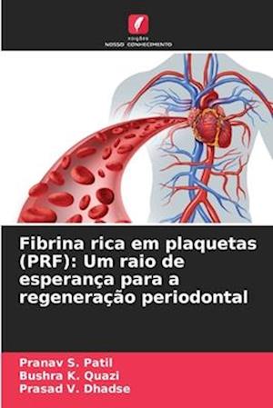 Fibrina rica em plaquetas (PRF): Um raio de esperança para a regeneração periodontal