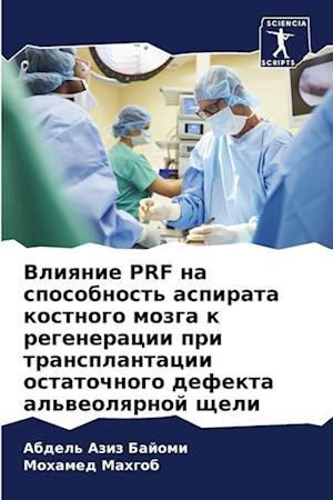 Vliqnie PRF na sposobnost' aspirata kostnogo mozga k regeneracii pri transplantacii ostatochnogo defekta al'weolqrnoj scheli