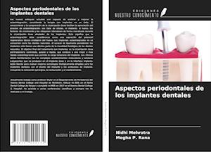 Aspectos periodontales de los implantes dentales