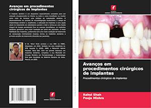 Avanços em procedimentos cirúrgicos de implantes