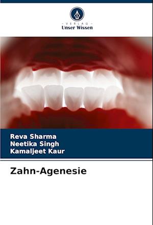 Zahn-Agenesie