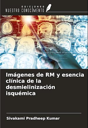 Imágenes de RM y esencia clínica de la desmielinización isquémica