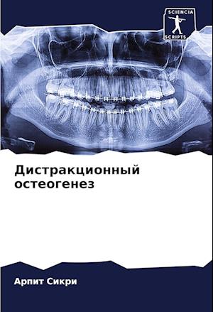 Distrakcionnyj osteogenez