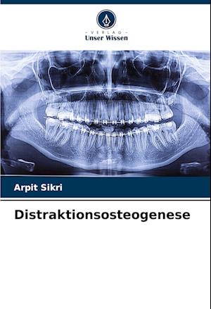 Distraktionsosteogenese