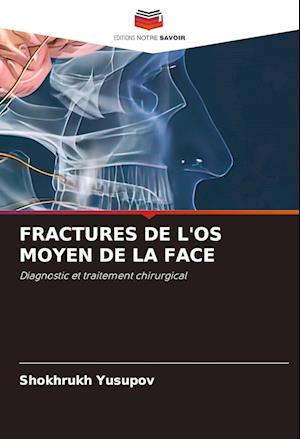 FRACTURES DE L'OS MOYEN DE LA FACE