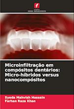 Microinfiltração em compósitos dentários: Micro-híbridos versus nanocompósitos