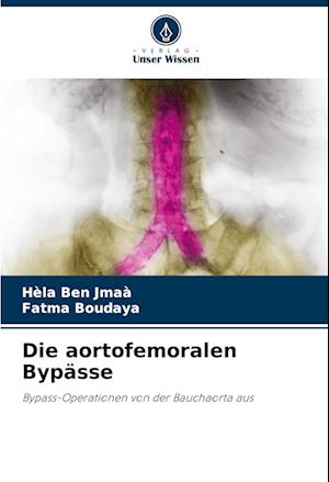 Die aortofemoralen Bypässe