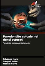 Parodontite apicale nei denti otturati