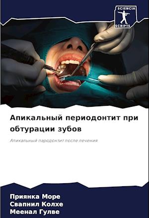 Apikal'nyj periodontit pri obturacii zubow