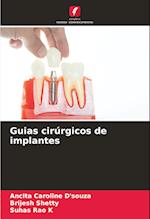 Guias cirúrgicos de implantes