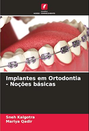 Implantes em Ortodontia - Noções básicas