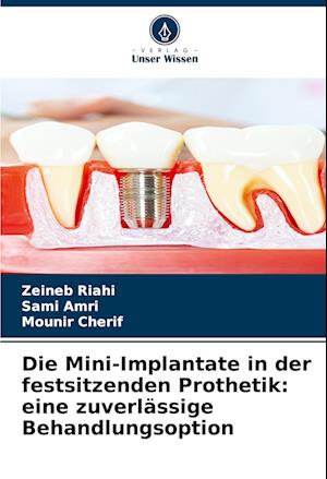 Die Mini-Implantate in der festsitzenden Prothetik: eine zuverlässige Behandlungsoption