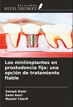 Los miniimplantes en prostodoncia fija: una opción de tratamiento fiable