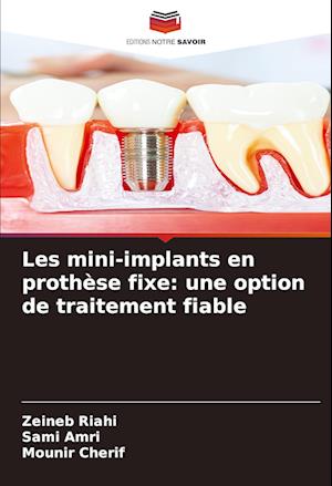 Les mini-implants en prothèse fixe: une option de traitement fiable