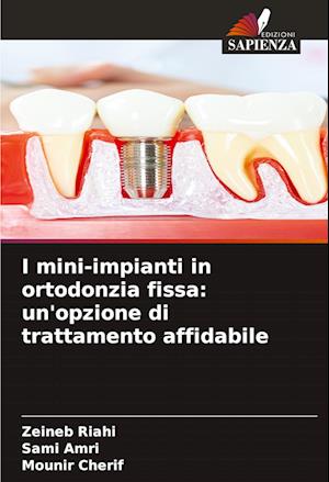 I mini-impianti in ortodonzia fissa: un'opzione di trattamento affidabile