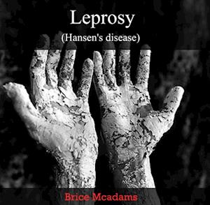 Leprosy (Hansen's disease)