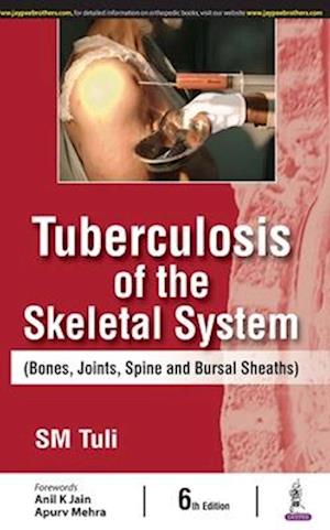 Tuberculosis of the Skeletal System