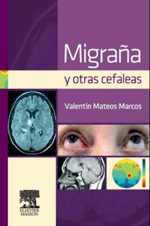 Migraña y otras cefaleas