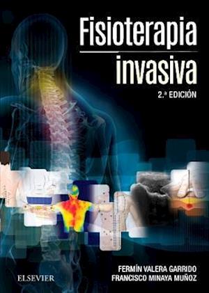 Fisioterapia invasiva