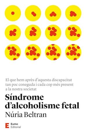 Síndrome d''alcoholisme fetal