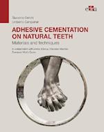 Adhesive cementation on natural teeth - Materials and techniques