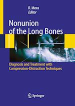 Nonunion of the Long Bones