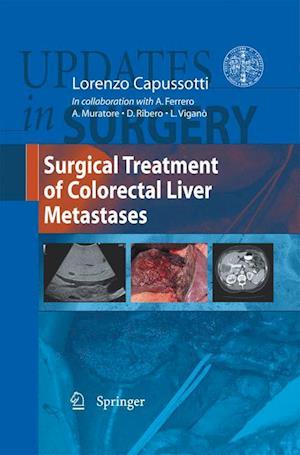 Surgical Treatment of Colorectal Liver Metastases