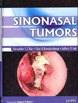 Sinonasal Tumors