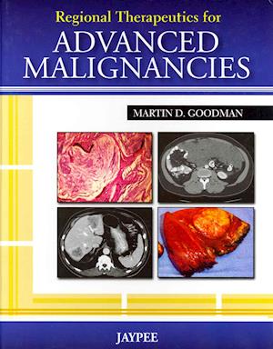 Regional Therapeutics for Advanced Malignancies