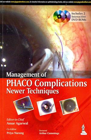 Management of Phaco Complications