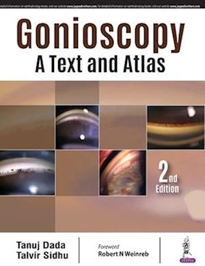 Gonioscopy: A Text and Atlas